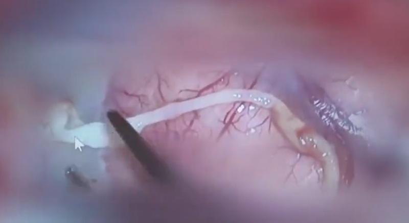 醫生最終成功捉到長度約10厘米仍在蠕動的裂頭絛蟲幼蟲。(微博)