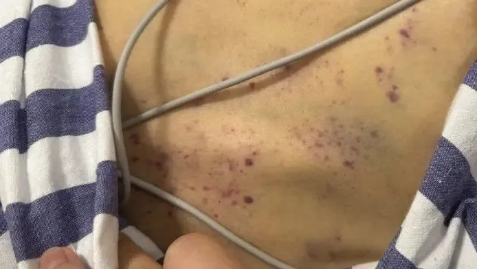 六旬納人中蛇毒後,頸胸有瘀點和瘀斑。