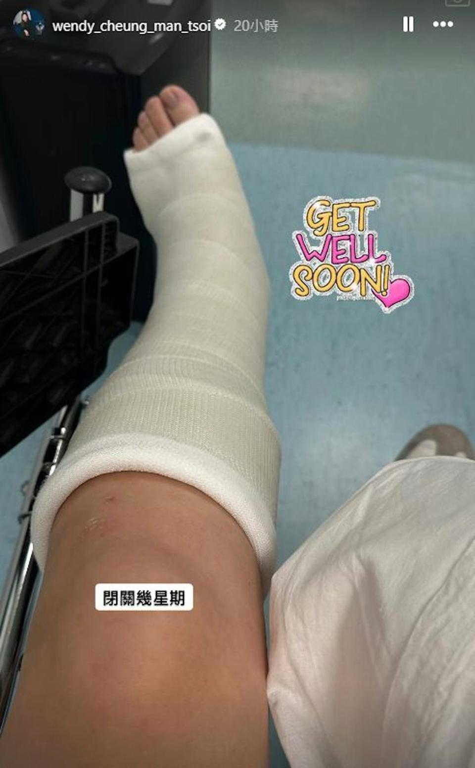張文采跌腳了左腳,由腳趾至膝蓋前位置都打了石膏。(IG@wendy_cheung_man_tsoi)