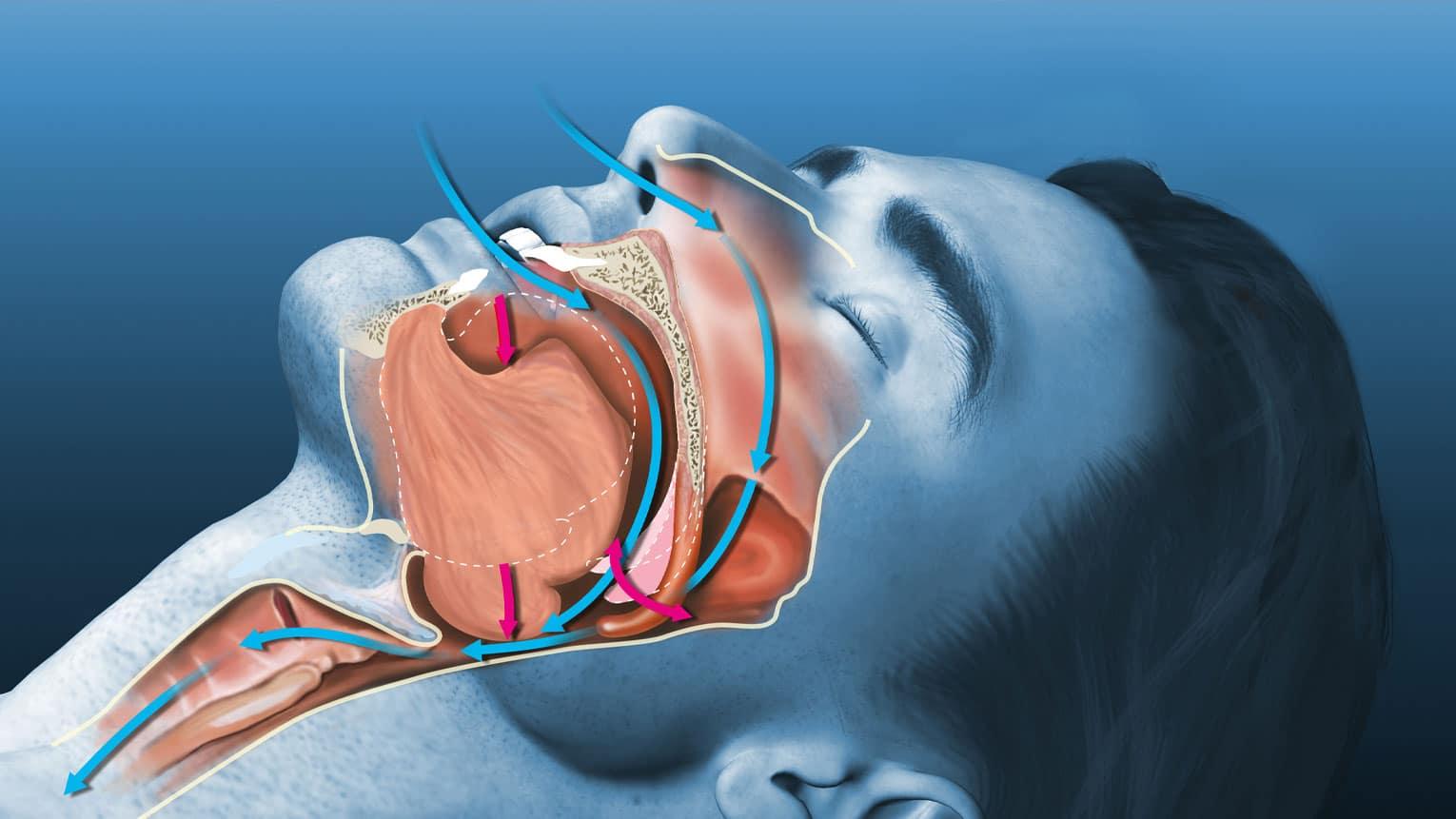 睡眠窒息影響牙齒健康?