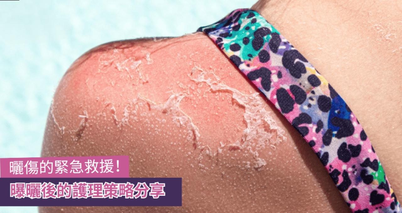 曬傷的緊急救援 曝曬後的護理策略分享