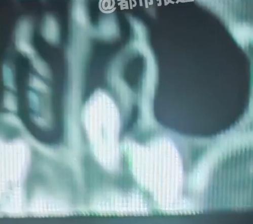 醫生透過電腦掃描(CT)發現,孩子鼻腔內藏有一顆異常生長的牙齒。(微博)