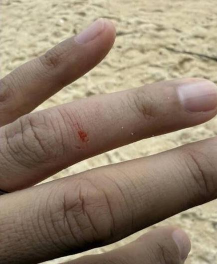 有網民展示被牠咬傷的傷疤。(X)