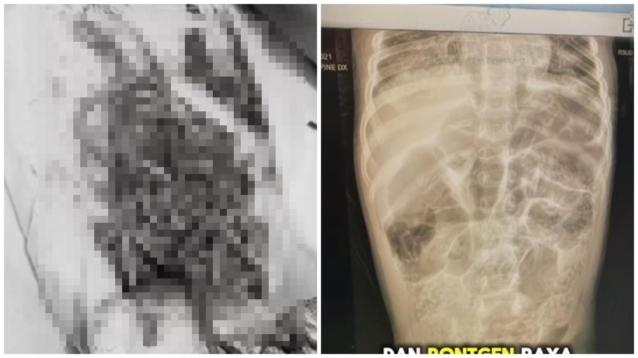 4歲女童鼻孔爬出15厘米活蟲,體內藏1公斤蛔蟲搶救10日亡。(IG)