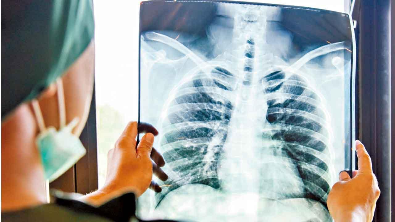 肺炎香港一直不夠重視的死因