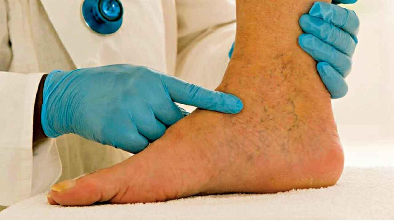 腳腫