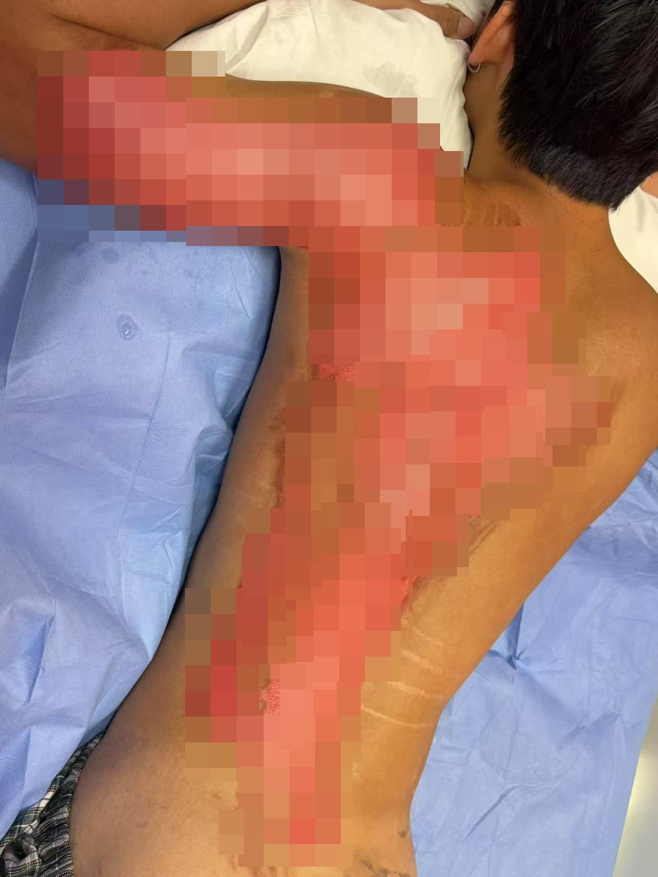 有網民在社交平台上發文,指自己的19歲兒子在天水圍置富+WOO嘉湖商場譚仔雲南米線用餐時,一名職員在拿熱水壺時不小心倒瀉,並淋到他的背部,其後被送到醫院留院,醫生診斷為二級燙傷。(Threads)