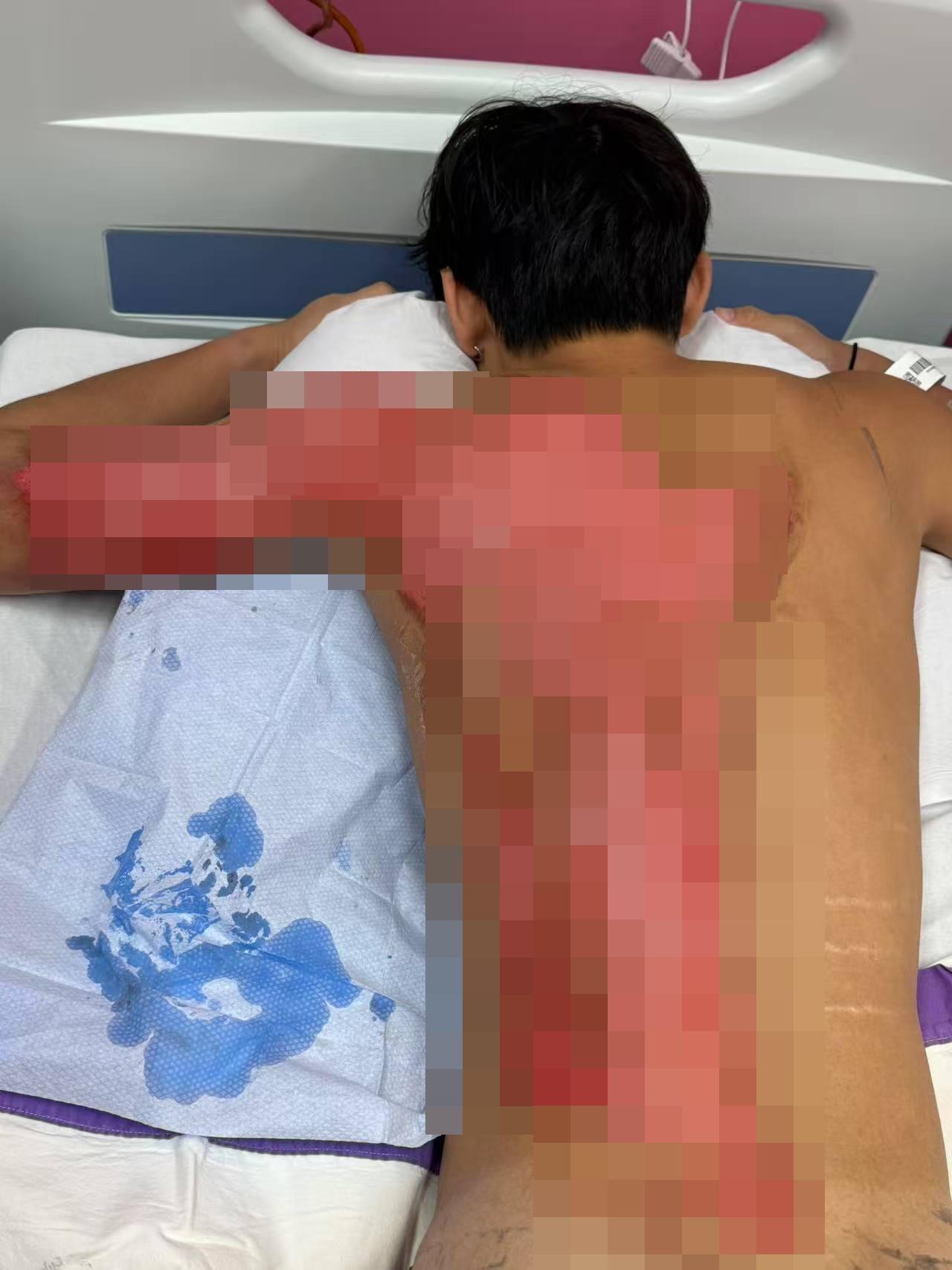 有網民在社交平台上發文,指自己的19歲兒子在天水圍置富+WOO嘉湖商場譚仔雲南米線用餐時,一名職員在拿熱水壺時不小心倒瀉,並淋到他的背部,其後被送到醫院留院,醫生診斷為二級燙傷。(Threads)