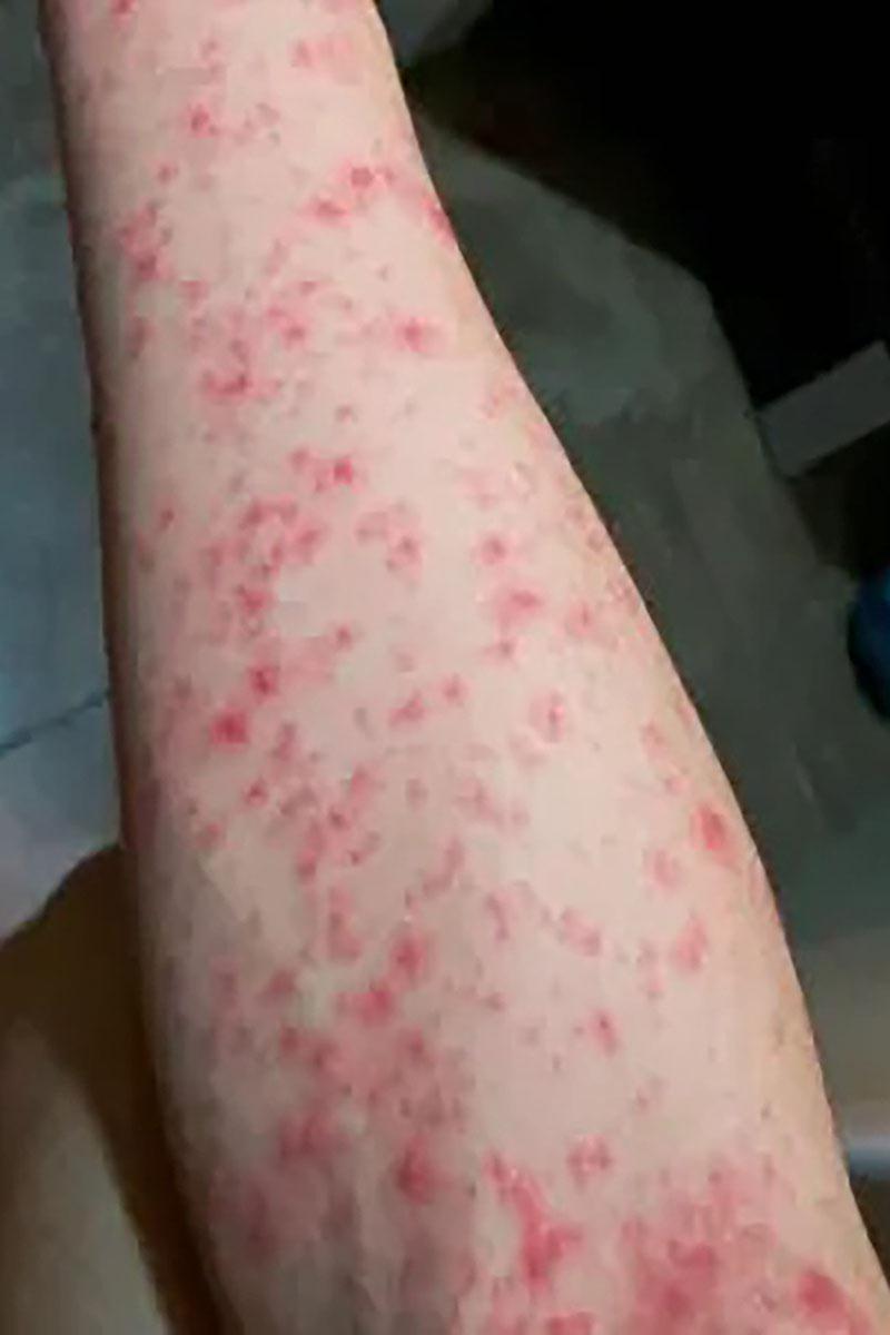 三水區政府發布多張基孔肯雅熱患者出現皮疹的照片。(微信公眾號「三水發布」)