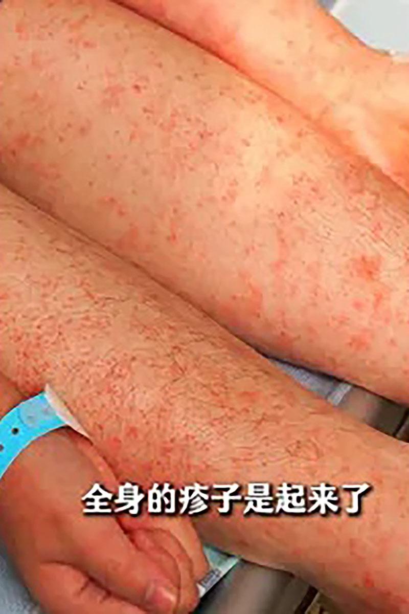 三水區政府發布多張基孔肯雅熱患者出現皮疹的照片。(微信公眾號「三水發布」)