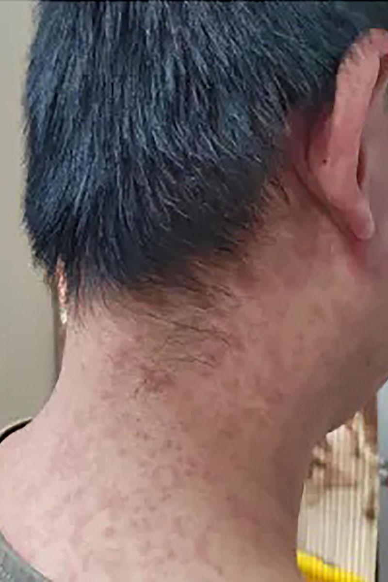 三水區政府發布多張基孔肯雅熱患者出現皮疹的照片。(微信公眾號「三水發布」)