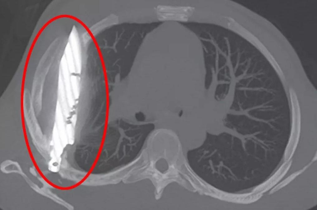 胸部X光影像可見,有一把刀插在男病人胸腔內。(互聯網)