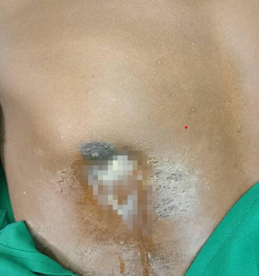 男子右邊乳頭持續流膿。(互聯網)