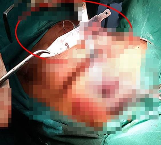 醫生們動手術,取出男子胸腔內的利刀。(互聯網)