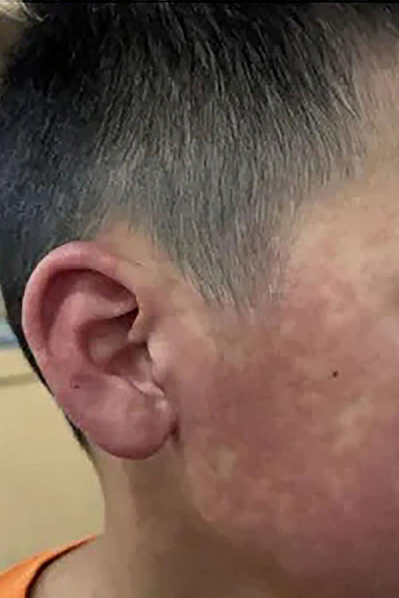 三水區政府發布多張基孔肯雅熱患者出現皮疹的照片。(微信公眾號「三水發布」)