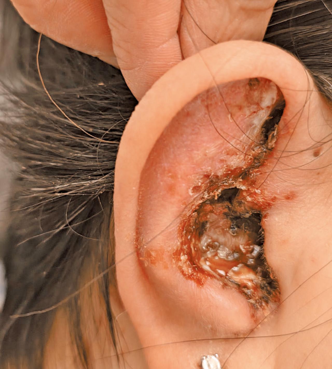 腎臟移植患者 耳朵疱疹 生蛇