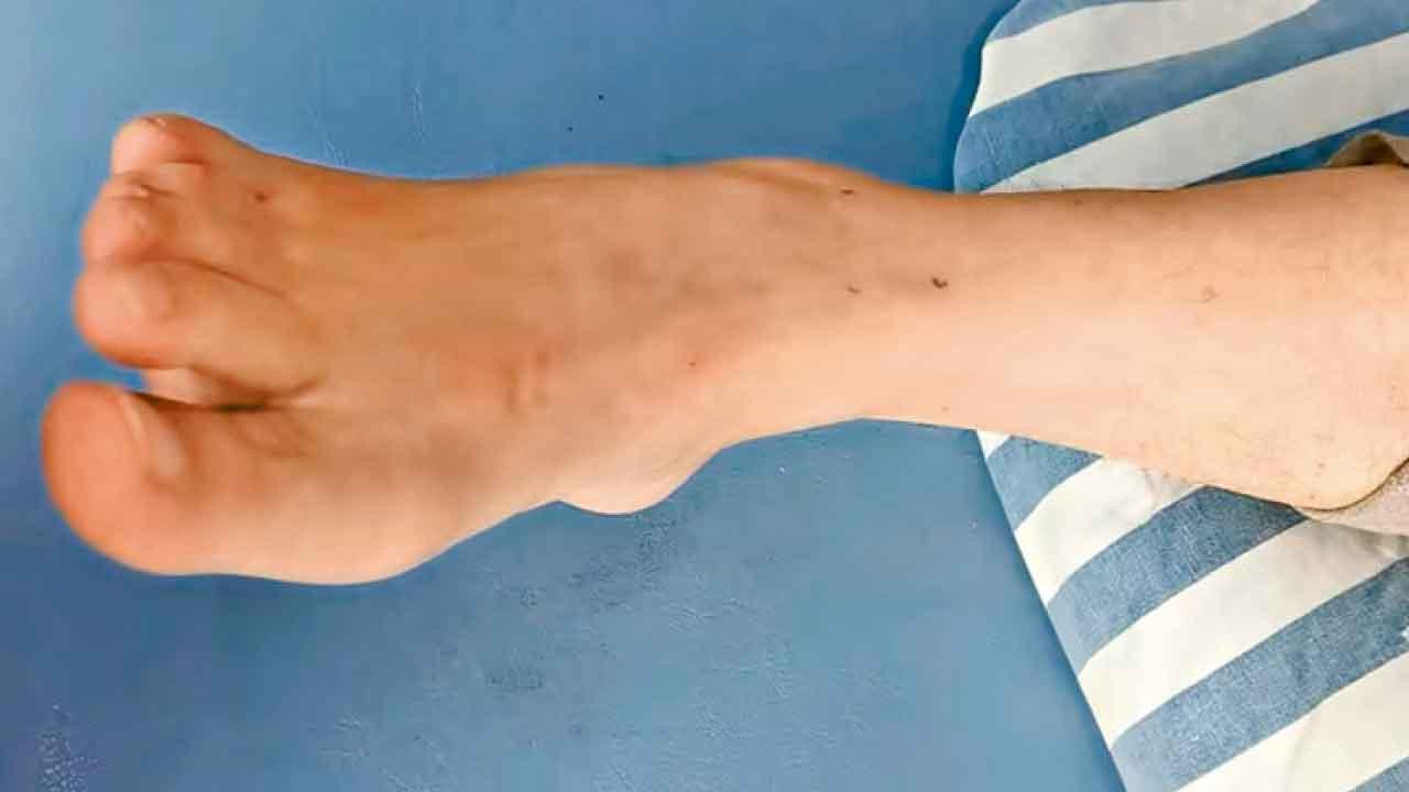 足內翻