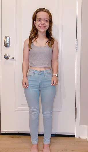 克魯斯接受肢體延長手術後。(互聯網)