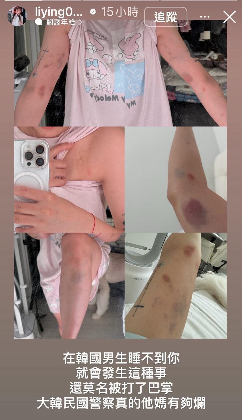 台灣女網紅南韓遇陌生男搭訕拒「過夜」 遭暴打周身瘀傷手指骨折| am730