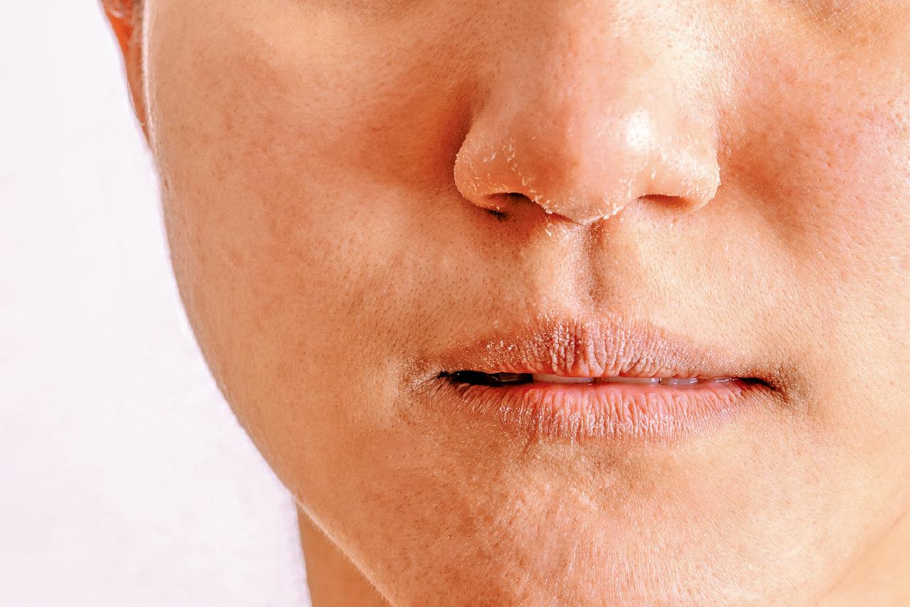 健康生活|新型治療助濕疹患者走出困境