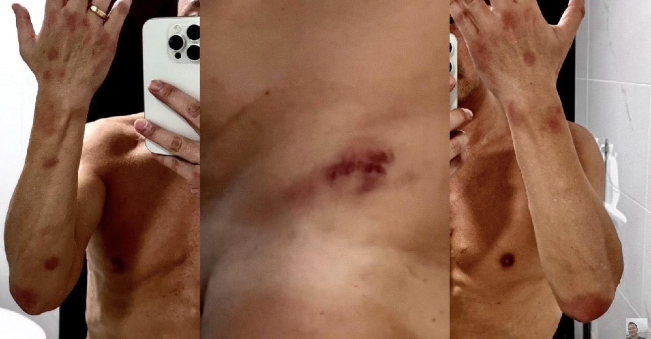 王喜早前公開在台灣兩度被迷姦,全身滿佈傷痕。