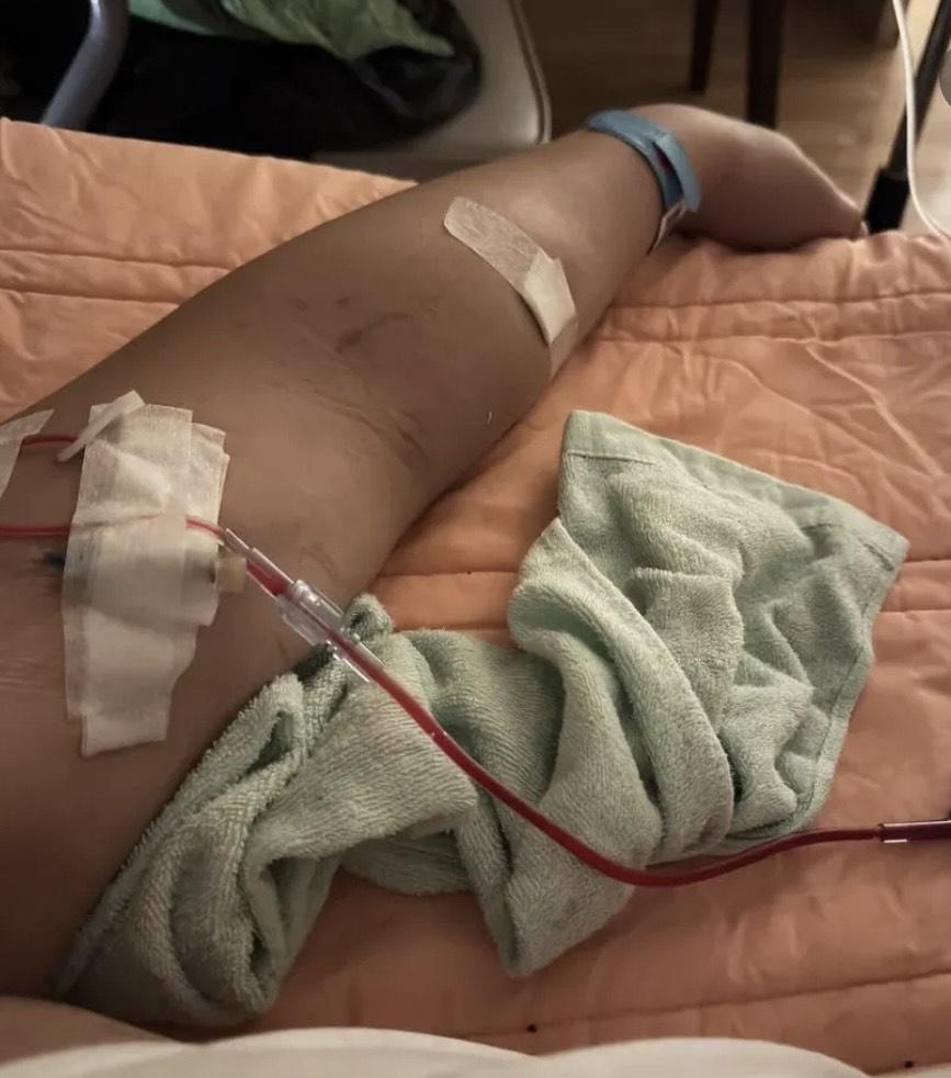 王喜自爆患上腎衰竭,需要終身洗腎。