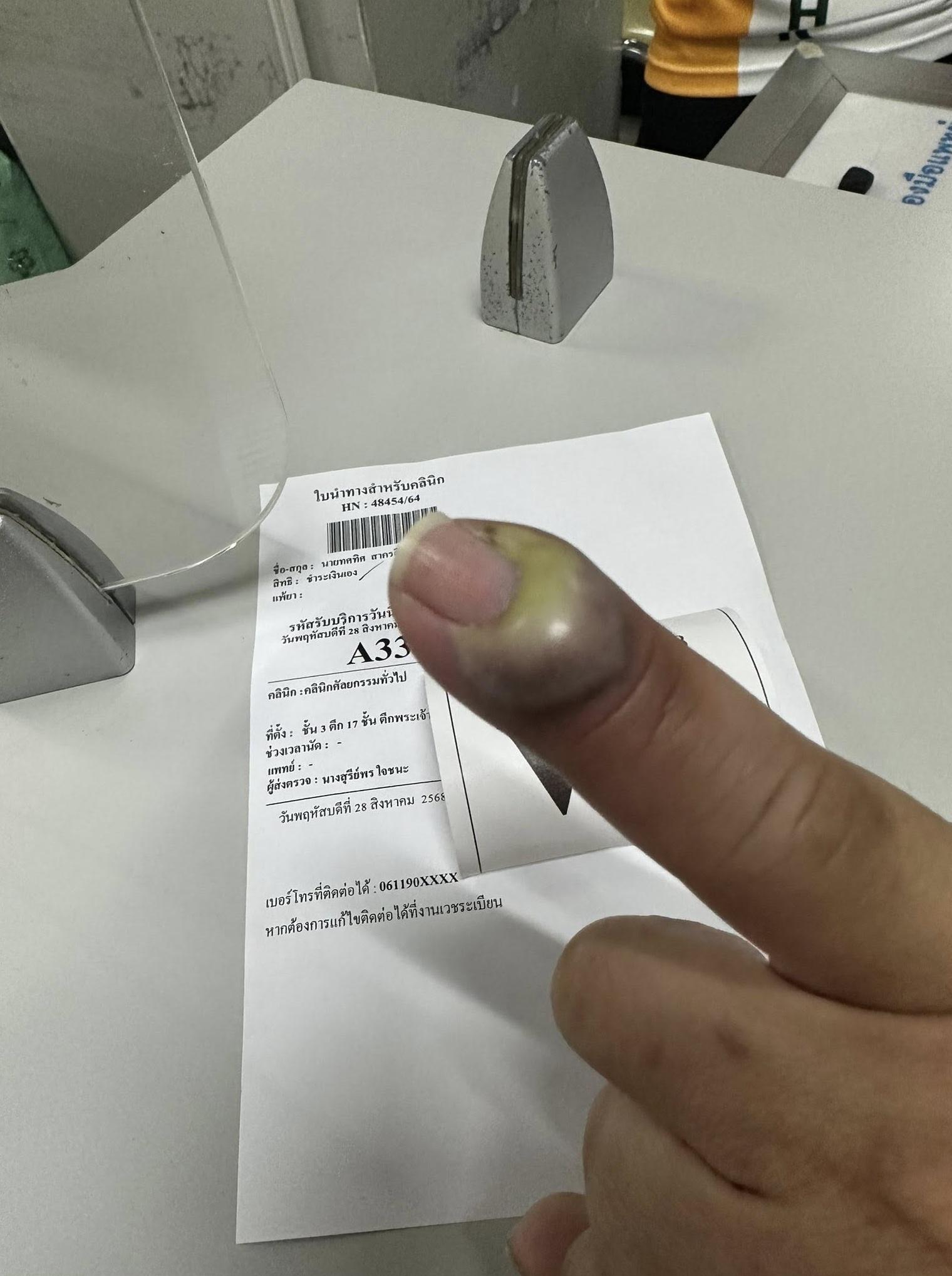 寵物美容師的右手尾指化膿嚴重,整塊腫起。(互聯網)