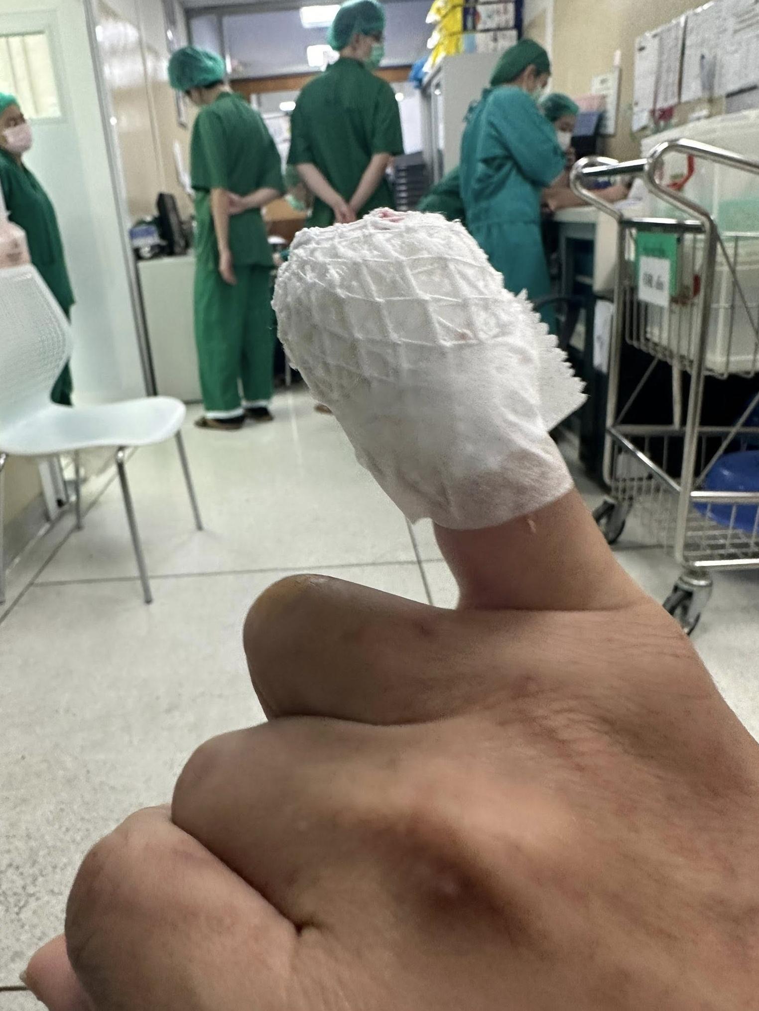 寵物美容師的右手尾指經治療後包紮好。(互聯網)