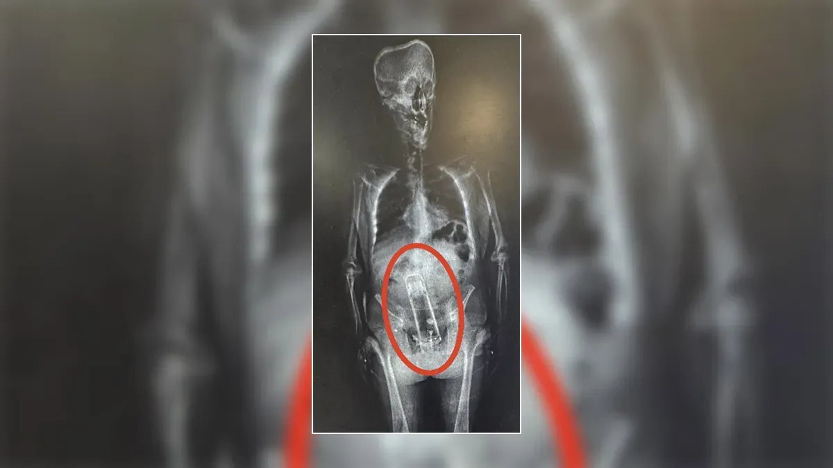 保溫瓶塞入肚內的X光片。