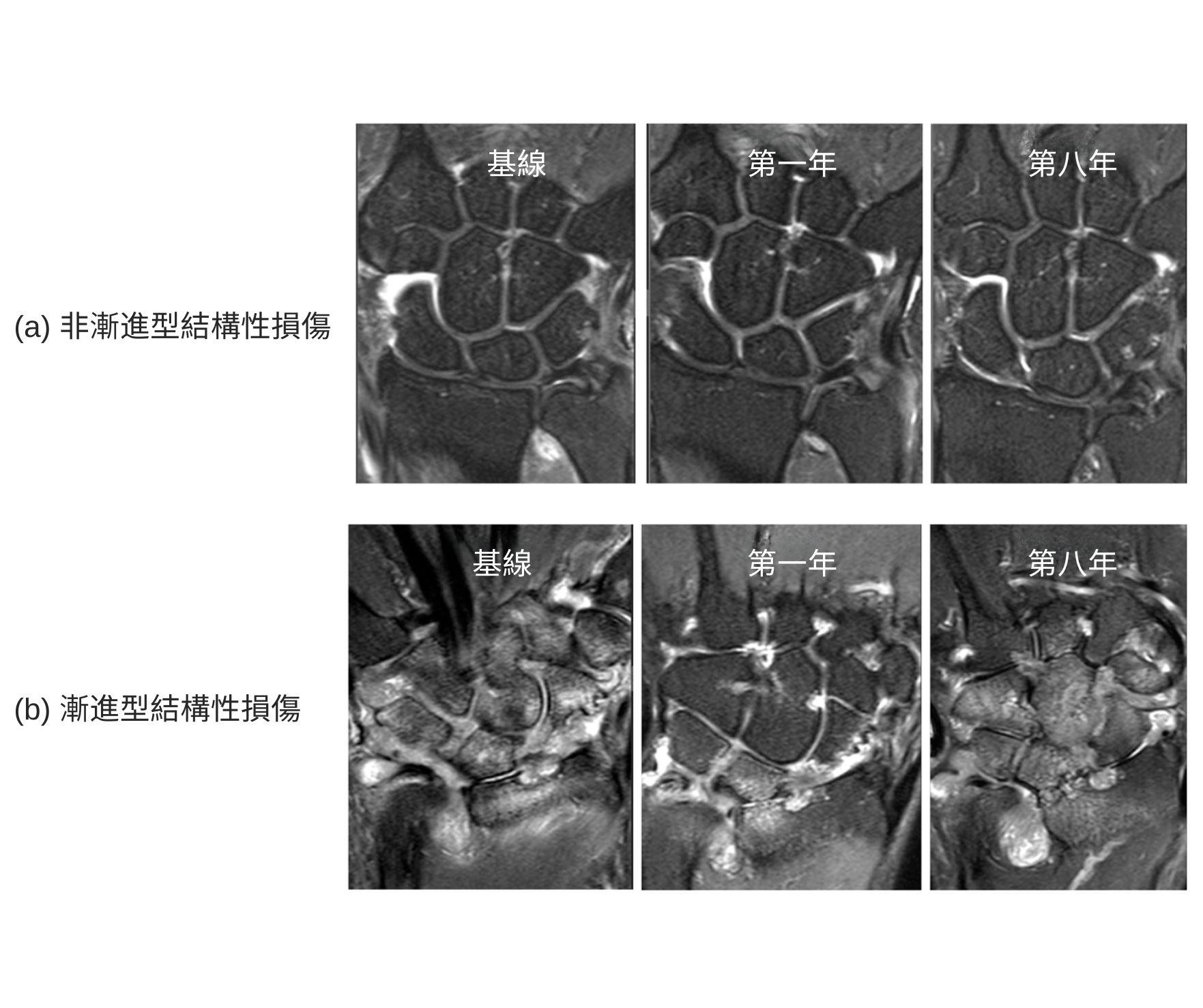 中大醫學院對類風濕關節炎患者進行全球有史以來歷時最長的磁力共振研究(MRI),首次發現非漸進型及漸進型結構性損傷。