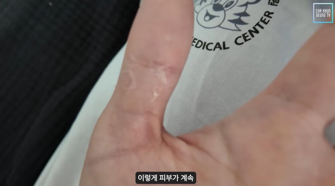 治療期的副作用,手掌皮膚甩掉。