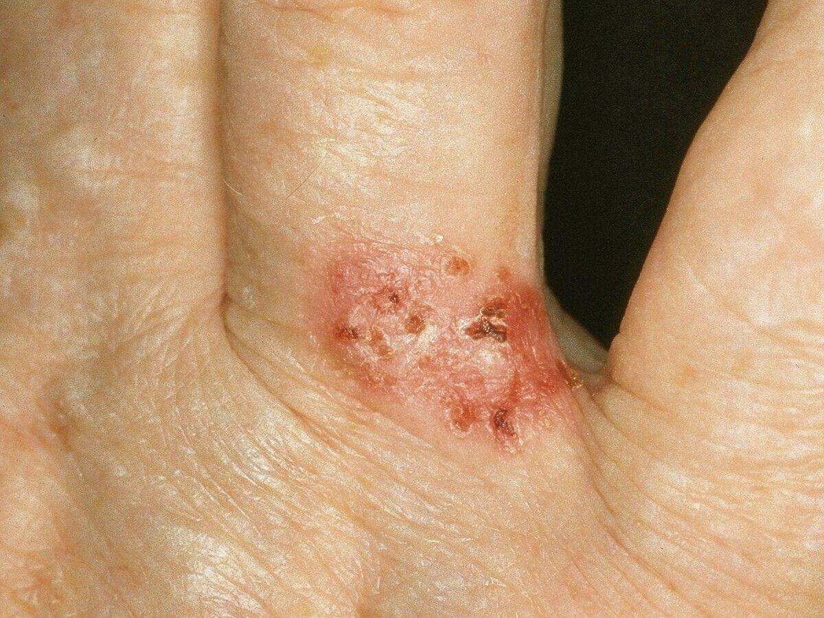 表淺型病變須和皮膚原位鱗狀細胞癌(波文式症Bowen's disease)作鑑別,兩者皆和砷化物有關。