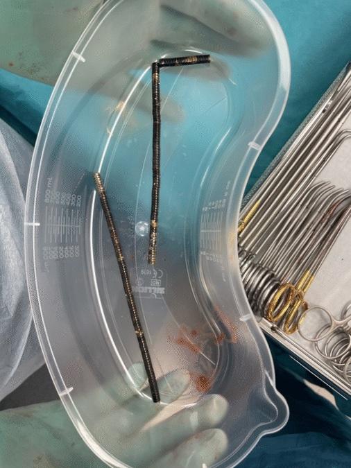 新西蘭男童吞200舊磁鐵,經手術後取出。(新西蘭醫學雜誌)