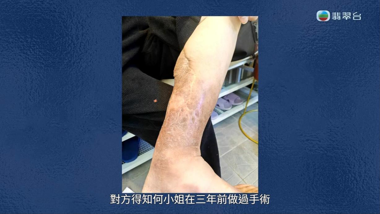 八両菜的左腳早年接受過手術。