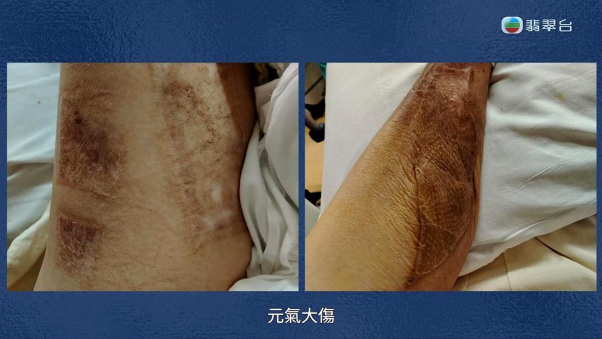 八両菜的左腳早年接受過手術。