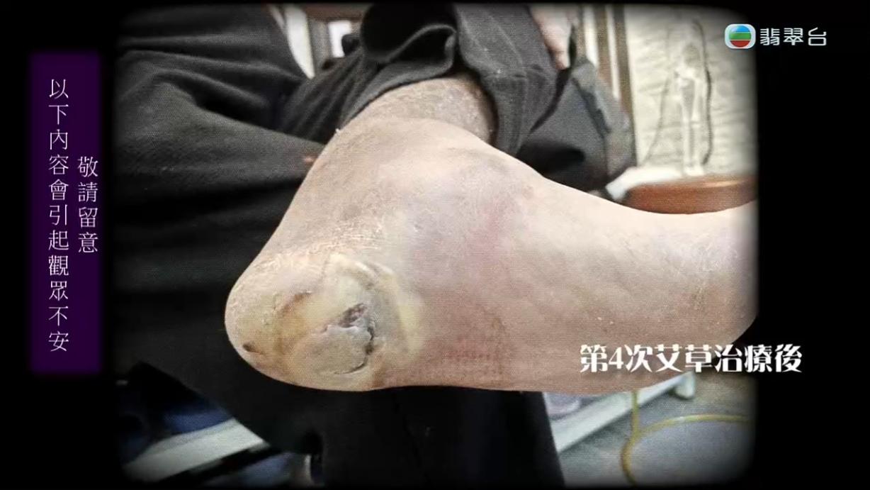 八両菜因為一個水泡搞到細菌受到感染,陳醫師的處理手法令人質疑。