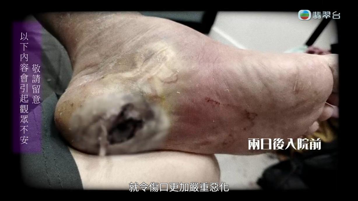 八両菜左腳情況愈來愈嚴重,陳醫師的處理手法令人質疑。