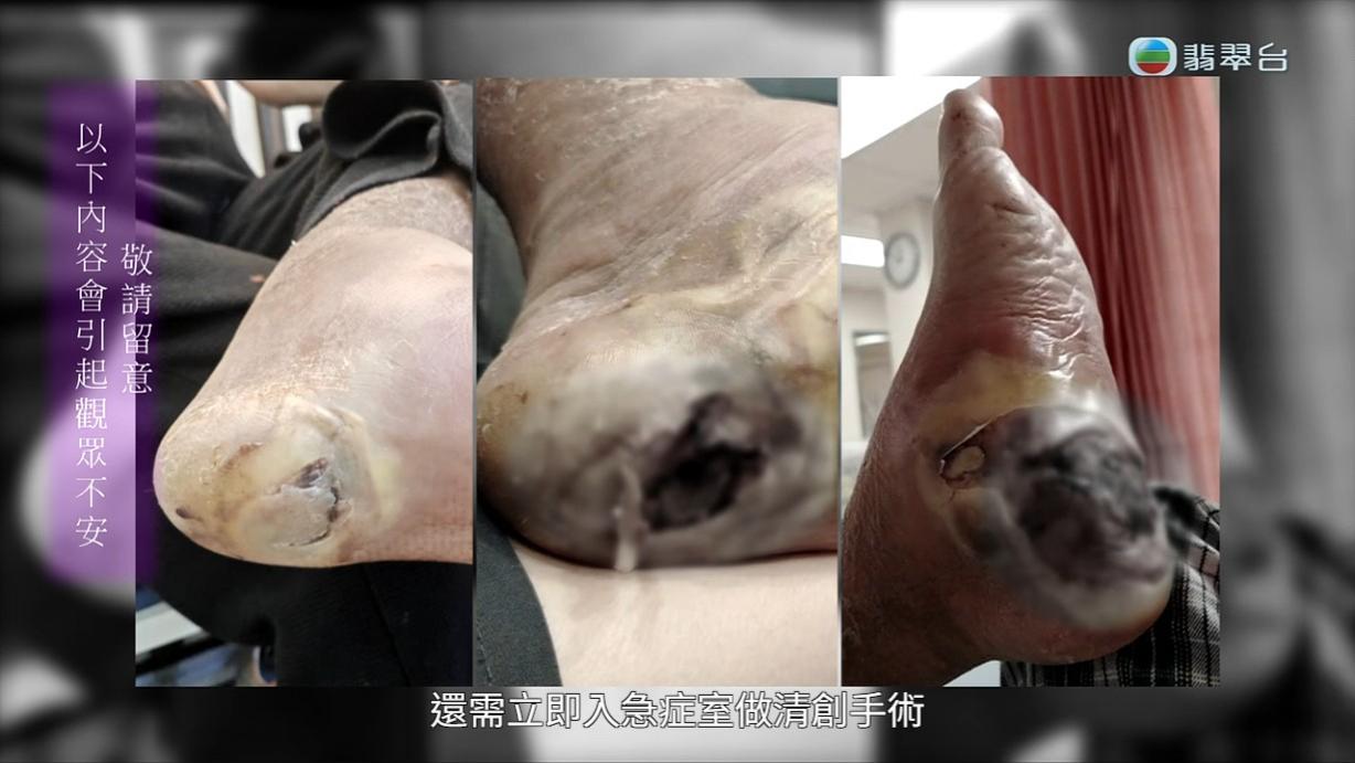 八両菜左腳情況愈來愈嚴重,陳醫師的處理手法令人質疑。