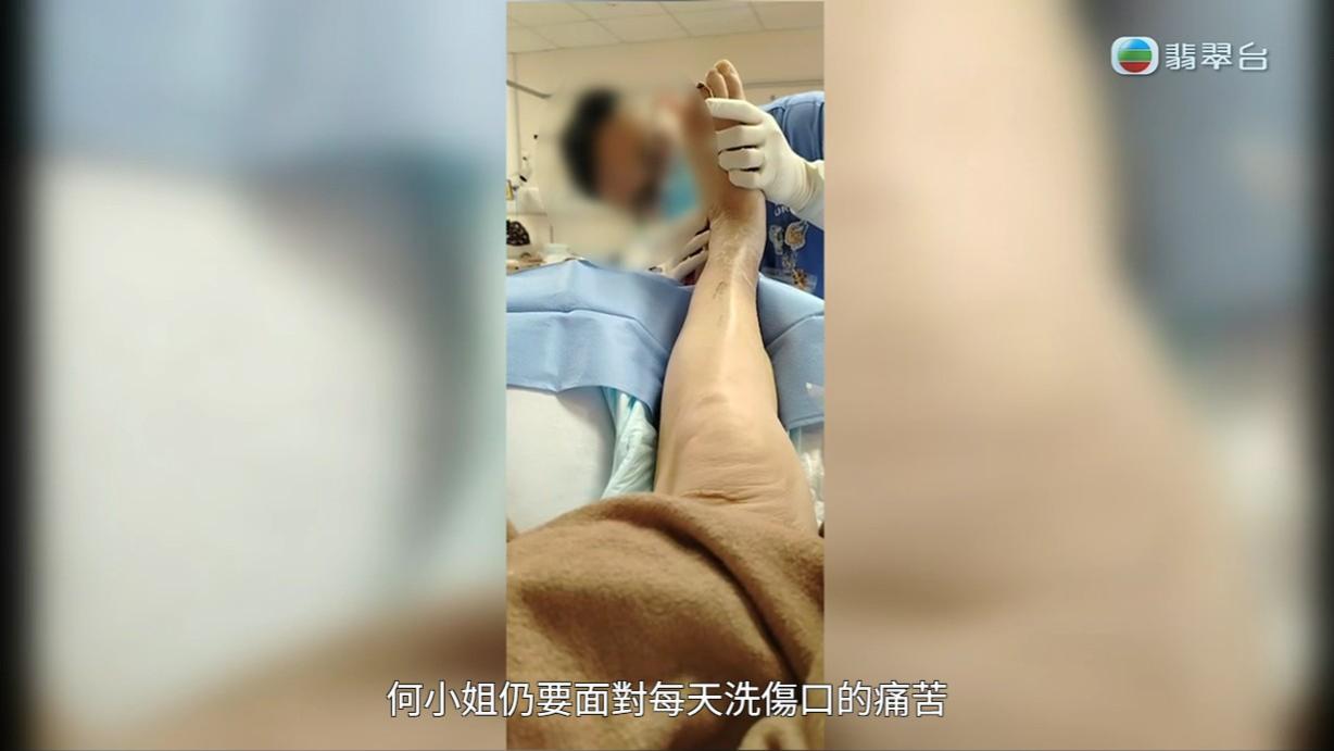 八両菜需要每日清洗傷口,但又因為出血水的問題嚴重,其中一次更令她要接受輸血。