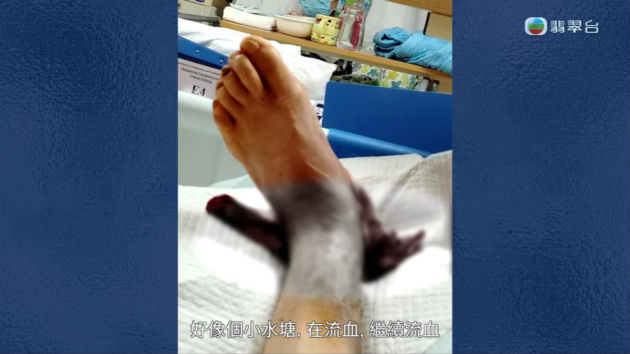 八両菜需要每日清洗傷口,但又因為出血水的問題嚴重,其中一次更令她要接受輸血。