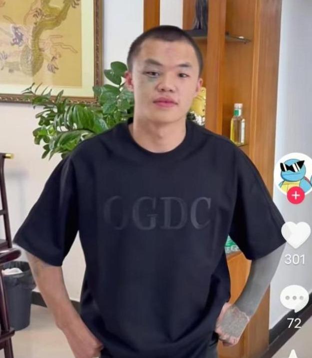 「紋面男孩」夏朝勇清洗3次紋身後,臉部大部分刺青已經褪去。