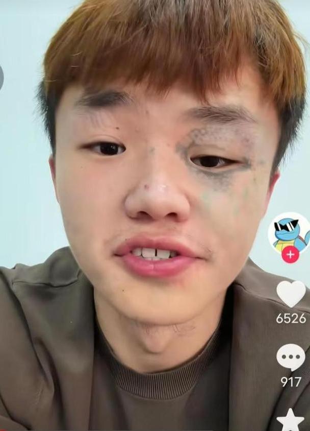 「紋面男孩」夏朝勇清洗3次紋身後,臉部大部分刺青已經褪去。