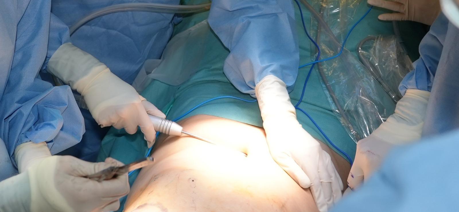 此項臨床試驗在乳房保留手術中即時結合自體脂肪移植技術重塑乳房,該技術從患者身體脂肪較多的部位抽取脂肪,經處理後再注射至乳房。