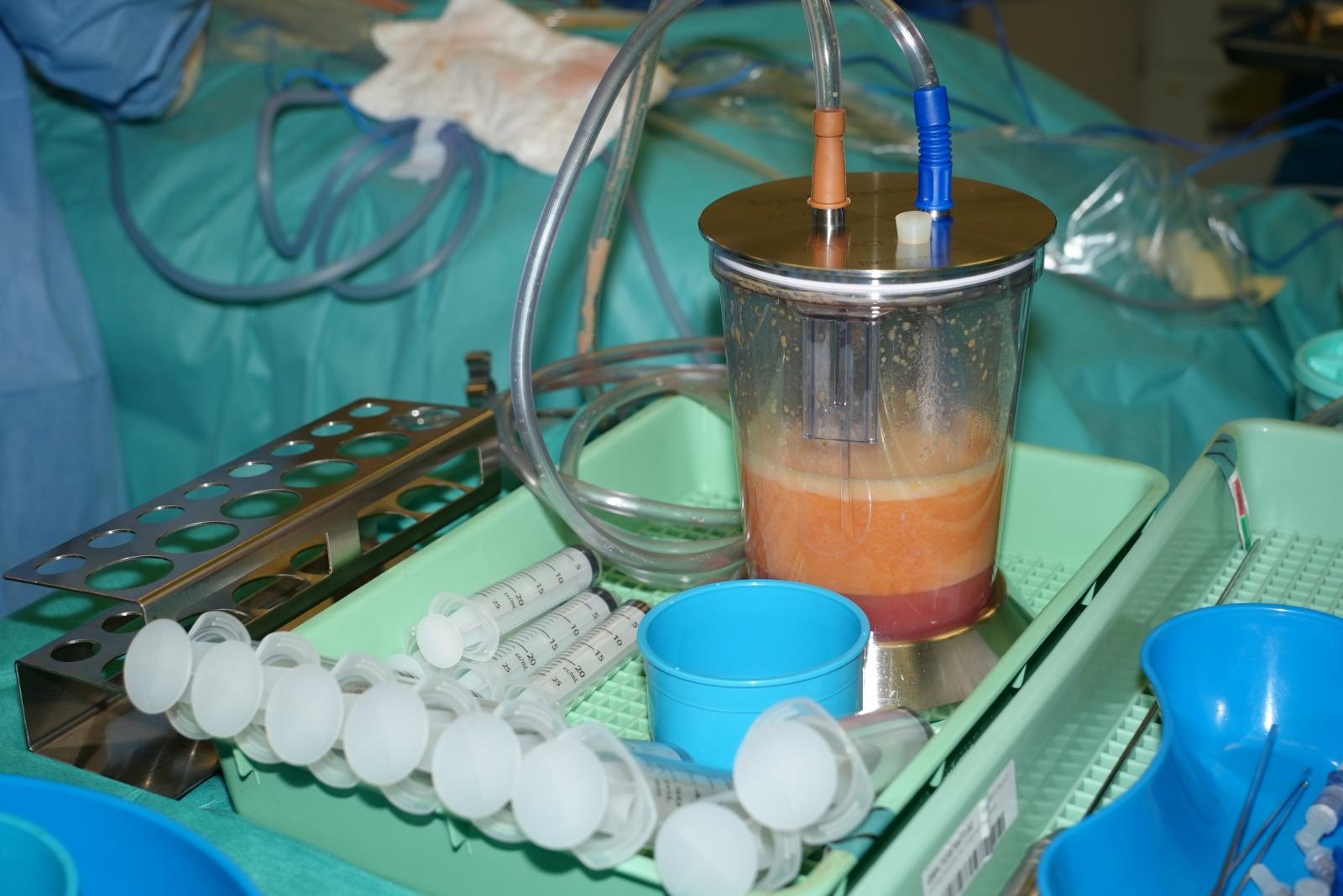 此項臨床試驗在乳房保留手術中即時結合自體脂肪移植技術重塑乳房,該技術從患者身體脂肪較多的部位抽取脂肪,經處理後再注射至乳房。