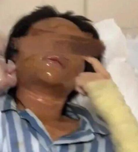 女網紅臉部二級燒傷。