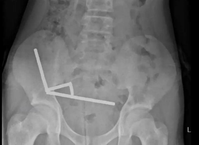 新西蘭男童吞200舊磁鐵後照X光。(新西蘭醫學雜誌)