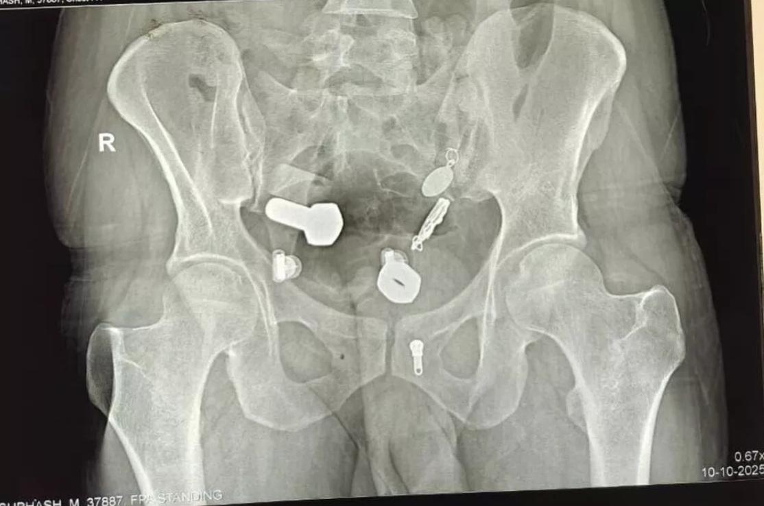 X光檢查發現,男子腸道裡有鐵片、螺絲帽、螺絲等異物。(互聯網)