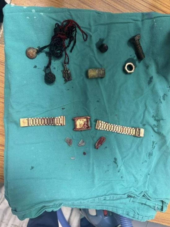 醫生從男子的食道和腸道取出手錶、鐵片、螺絲帽、螺絲和繩子等異物。(互聯網)