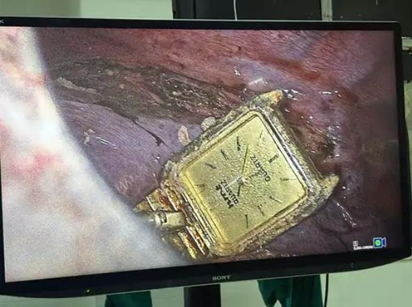 手術過程被拍下,醫生從男子腹部的小切口拉出手錶。(互聯網)