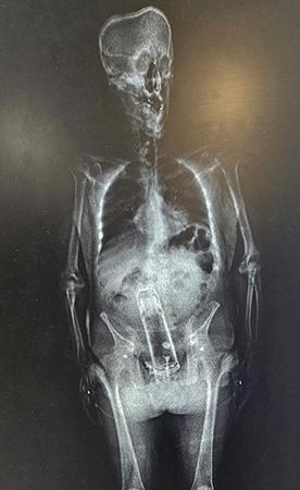 保溫瓶最後以手術取出體外。